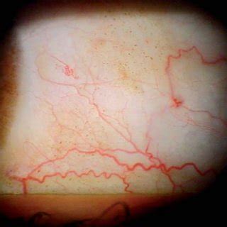 Temporal conjunctival Melanosis in LE. | Download Scientific Diagram