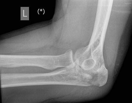 Olecranon Fractures - Trauma - Orthobullets