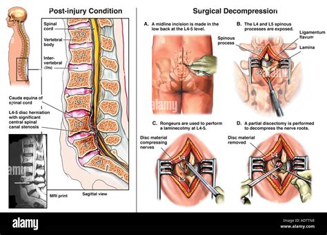 Lumbar Disc Herniation L4-5 with Surgical Laminectomy and Discectomy Stock Photo, Royalty Free ...