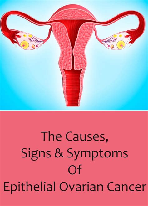 The Causes, Signs And Symptoms Of Epithelial Ovarian Cancer | Lady Care Health