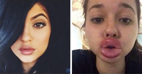 Kylie Jenner Challenge bruises teenagers' lips - The San Diego Union-Tribune