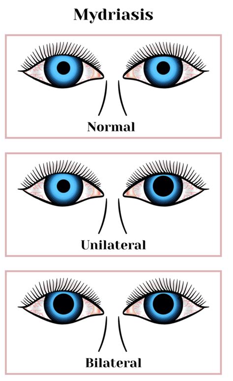 What Does It Mean When A Dogs Pupils Dilate