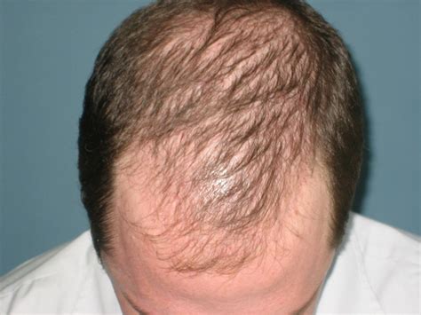 The Life Extension Blog: Want to Manage Male Pattern Baldness? Act Fast