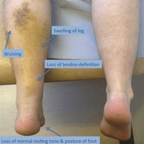 Achilles Tendon Rupture – Core EM