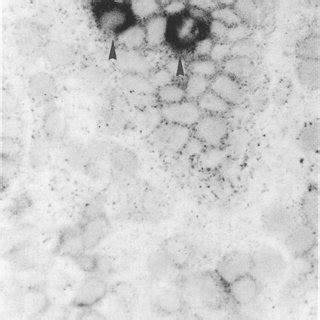 Two interleukin-2 receptor positive cells, shown by arrowheads, in a ...