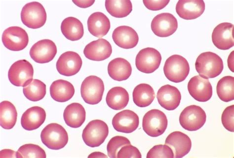 Morphologic Evaluation of Red Blood Cells | Medical Laboratories