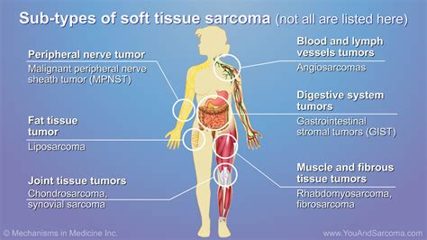 Understanding Soft Tissue Sarcoma