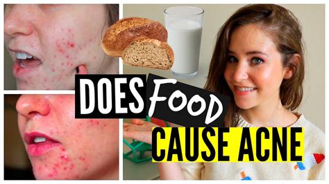 How To Get Rid Of Acne Naturally: Food, Diet, Wheat, Dairy, Sugar ...