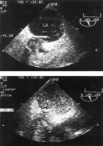 Transesophageal Echocardiography for Quantifying Size of Patent Foramen Ovale in Patients With ...
