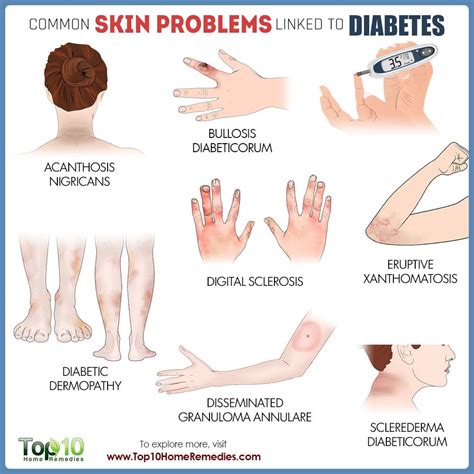 Common Skin Problems Linked to Diabetes | Top 10 Home Remedies