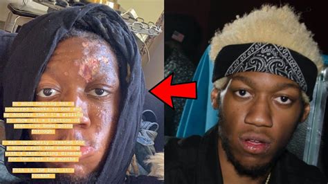 OG Maco Reveals He Has A Skin Eating Disease - YouTube