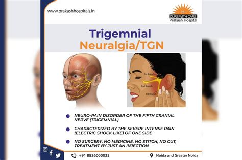 All you need to know about Trigeminal Neuralgia (TGN)