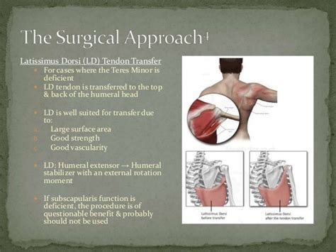 Reverse Total Shoulder Replacement, Final