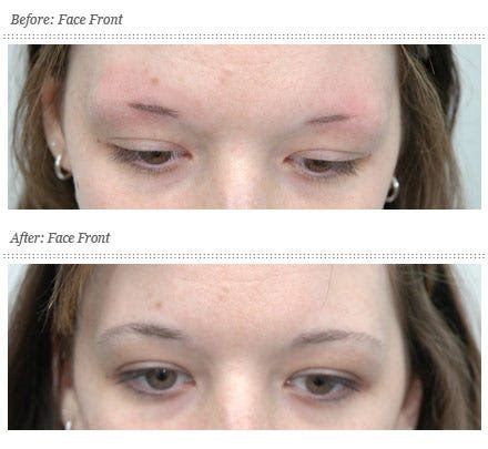 What is Best Treatment of Eyebrow Hair Loss | by Best Hair Transplant | Medium