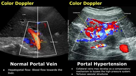 Portal Vein Color & Spectral Doppler Ultrasound Normal Vs Abnormal ...