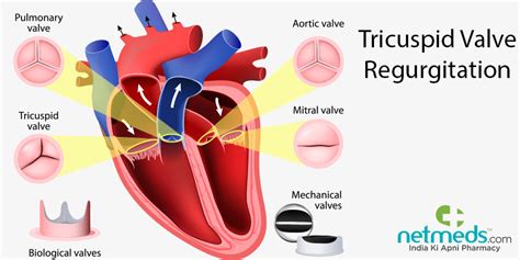 Tricuspid Valve Regurgitation: Causes, Symptoms And Treatment