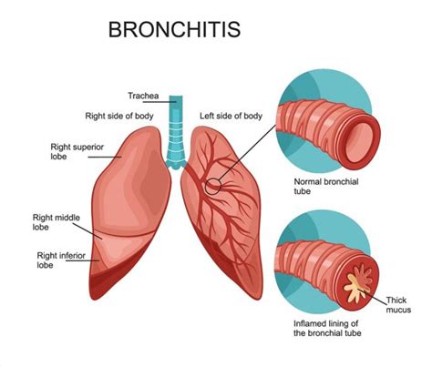 Chest Cold | symptoms, treatments, home remedies, anatomy, infographics