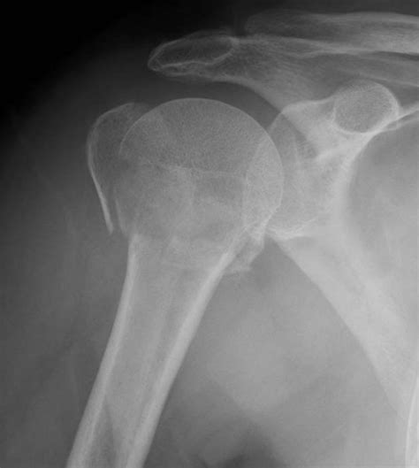 Proximal Humerus Neck Fracture