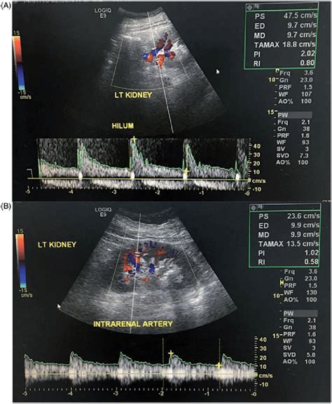 Renal Doppler measurements: (A) measurements on the renal artery of the ...