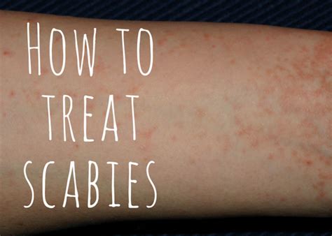 Top Over-the-Counter Scabies Treatments & Prescription Medications - YouMeMindBody