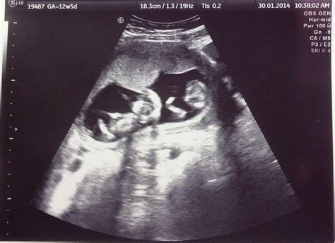 Fraternal Twins, 12 week ultrasound 12 Week Ultrasound, Baby Ultrasound Pictures, Pregnancy ...