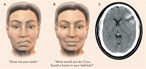 Facial Nerve Palsy examination | Resus