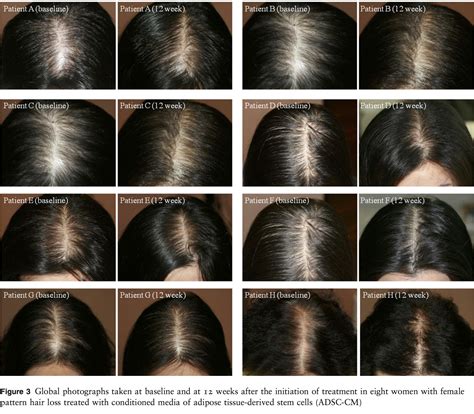 Female Pattern Baldness | Faculty of Medicine