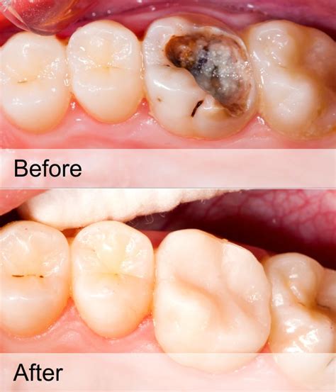 TOOTH CAVITY FILLING TREATMENT - MATRIX DENTAL AND SKIN LOUNGE