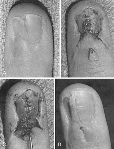 Perionychium | Musculoskeletal Key