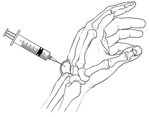 Ganglion Cyst Aspiration