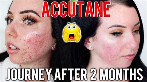 MY ACCUTANE JOURNEY 2 MONTH UPDATE Before & After, Side Effects, Skin Care Products I'm using ...