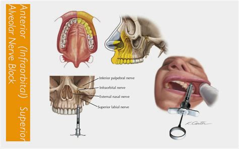 dentistry study: Anterior superior alveolar nerve block