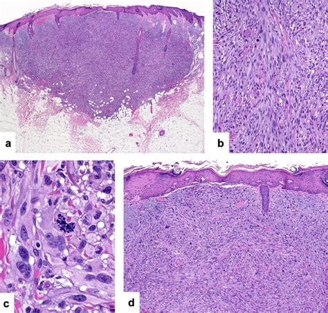 Spindle cell squamous cell carcinoma: This nodular tumor is centered... | Download Scientific ...