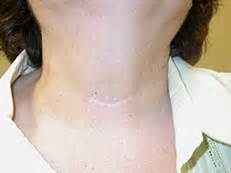 Scar After Thyroid Surgery. Minimally Invasive Thyroid Surgery, Alexander Shifrin, MD | www ...