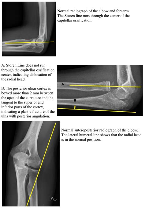 Radial Head Dislocation Article