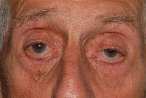 Ptosis (drooping) of the upper eyelid – BOPSS