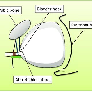 Bladder neck plication technique Bladder neck was plicated by running ...