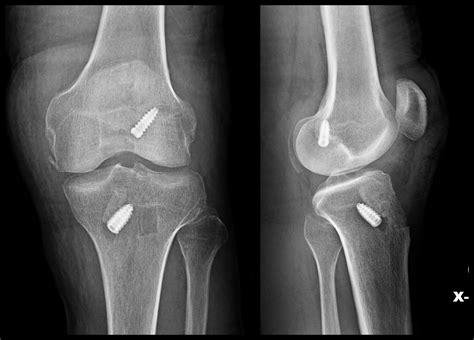 ACL Reconstruction (BTB autograft)