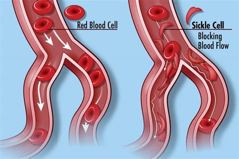 Sickle cell anemia and malaria - Simplebiol