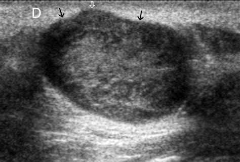 Subcutaneous Dermoid Cyst Ultrasound