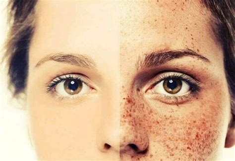 Laser Freckle Removal Victoria - Maya Laser Clinic