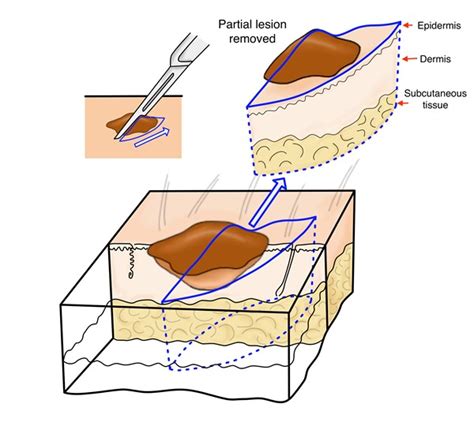 How to Perform a Wound Biopsy