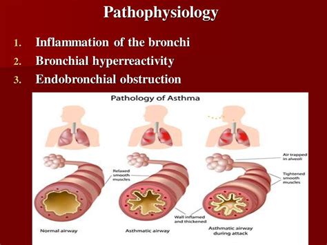 Bronchial asthma - презентация онлайн