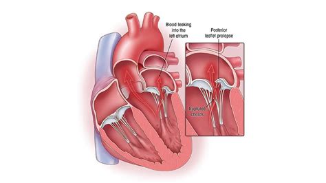 Minimally Invasive Mitral Valve Repair