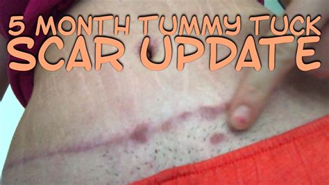 Scar Removal For Tummy Tuck at Kyle Morgan blog