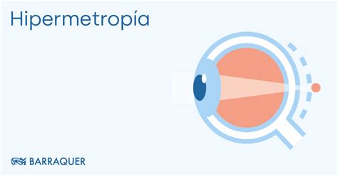 Hypermetropia (long-sightedness) | What it is, symptoms and treatment - Barraquer