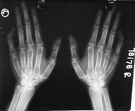 X-ray wrist and hand: 5 th finger camptodactyly, clinodactyly and ...