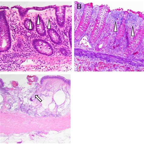 Histological examination. a Typical findings of collagenous colitis ...