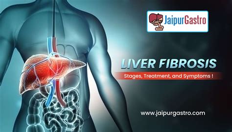 What is Liver Fibrosis: Stages, Treatment, and Symptoms - JaipurGastro