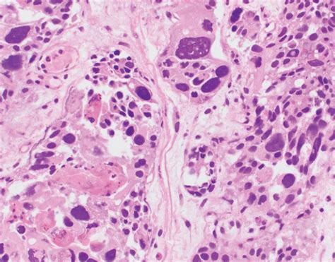 Histologic Variants of Urothelial Carcinoma: Morphology, Molecular Features and Clinical ...